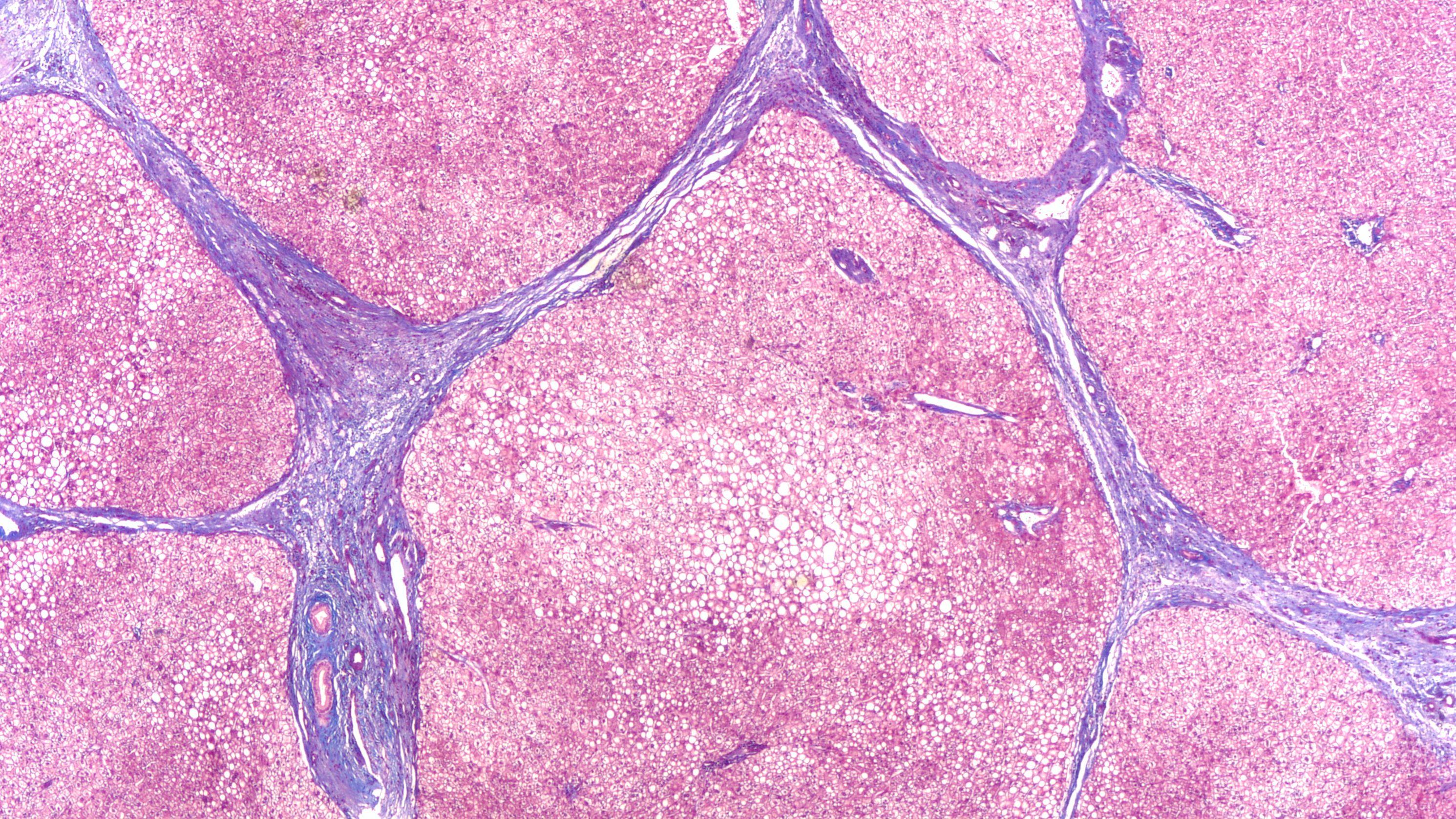 Photomicrograph of liver biopsy in a patient with cirrhosis, showing bridging septal fibrosis and regenerative nodules.