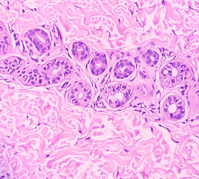 Prurigo nodularis seen in a hand skin biopsy.