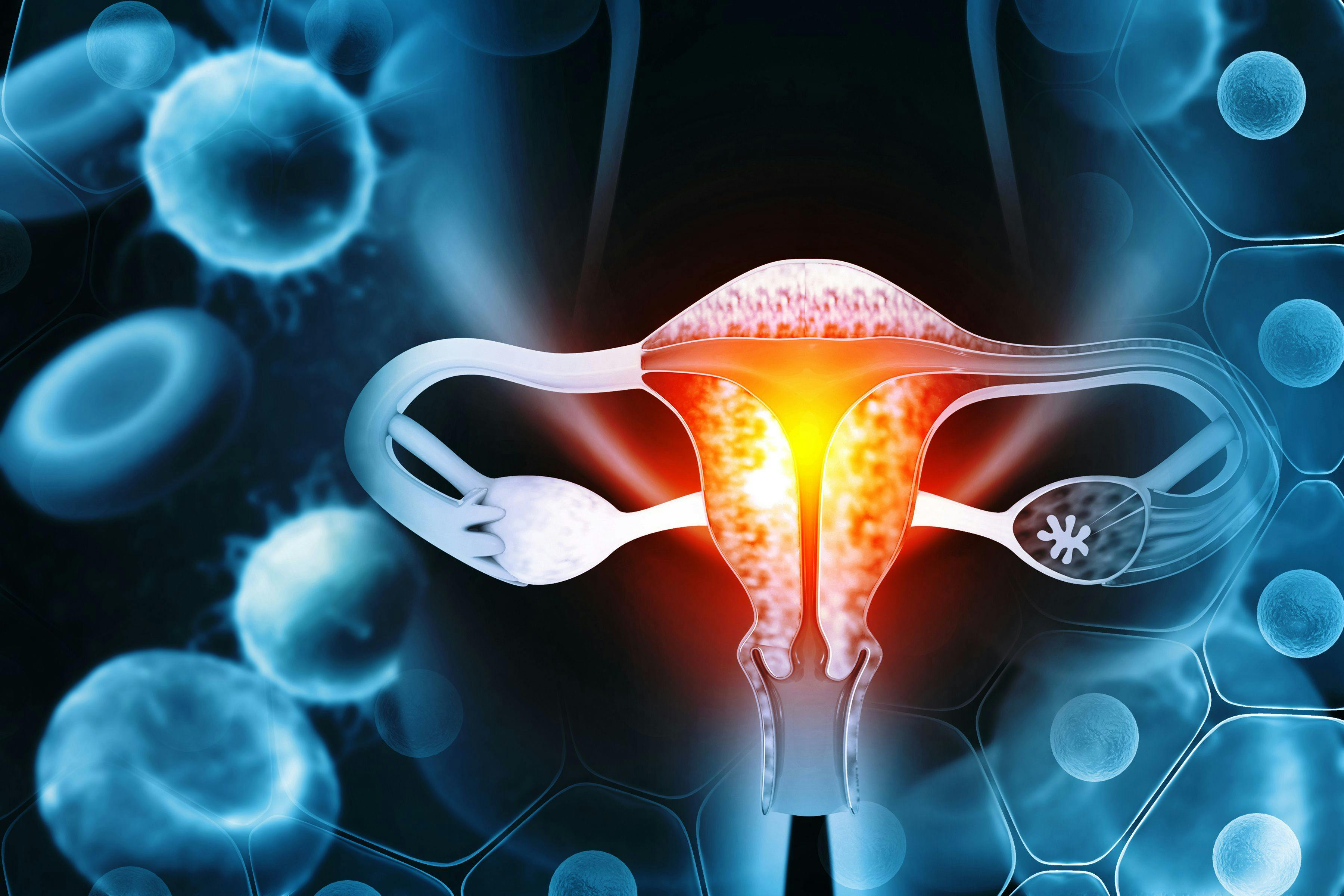 Endometrial cancer -- Image credit: Crystal light | stock.adobe.com