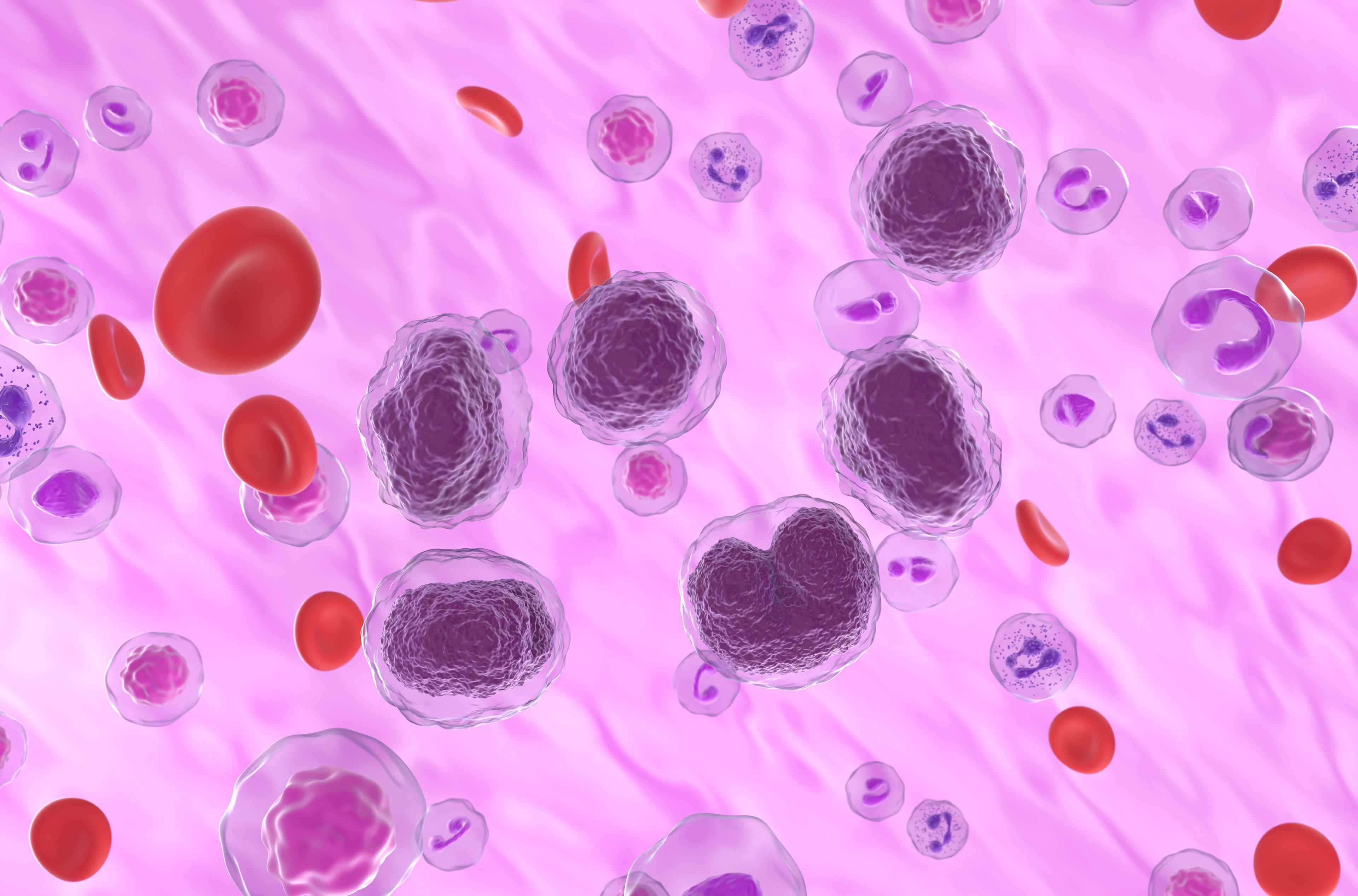 Non-Hodgkin lymphoma cells in the blood flow.