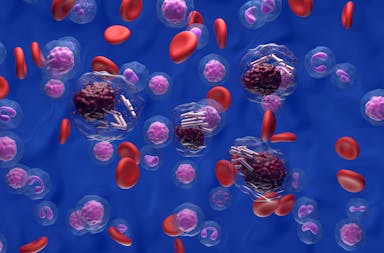 Chronic lymphocytic leukemia -- Image credit: LASZLO | stock.adobe.com