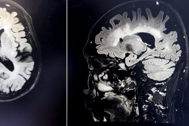 MRI scan showing dementia-related deterioration -- Image credit: Atthapon | stock.adobe.com