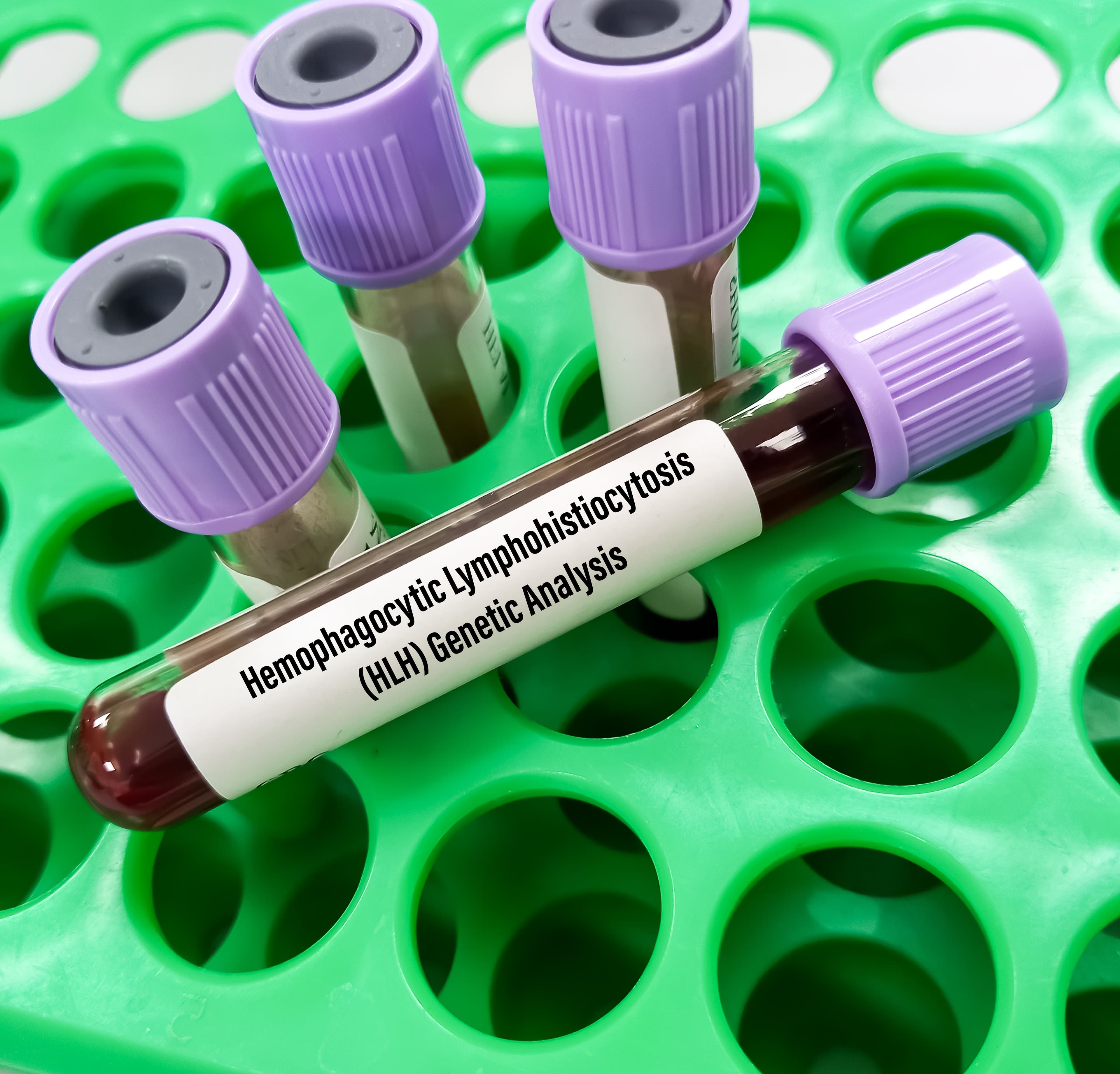 Blood sample for hemophagocytic lymphohistiocytosis(HLH) genetic analysis, HLH is a potentially fatal disease characterized by abnormal activation of T-lymphocytes and macrophages - Image credit: MdBabul |stock.adobe.com 