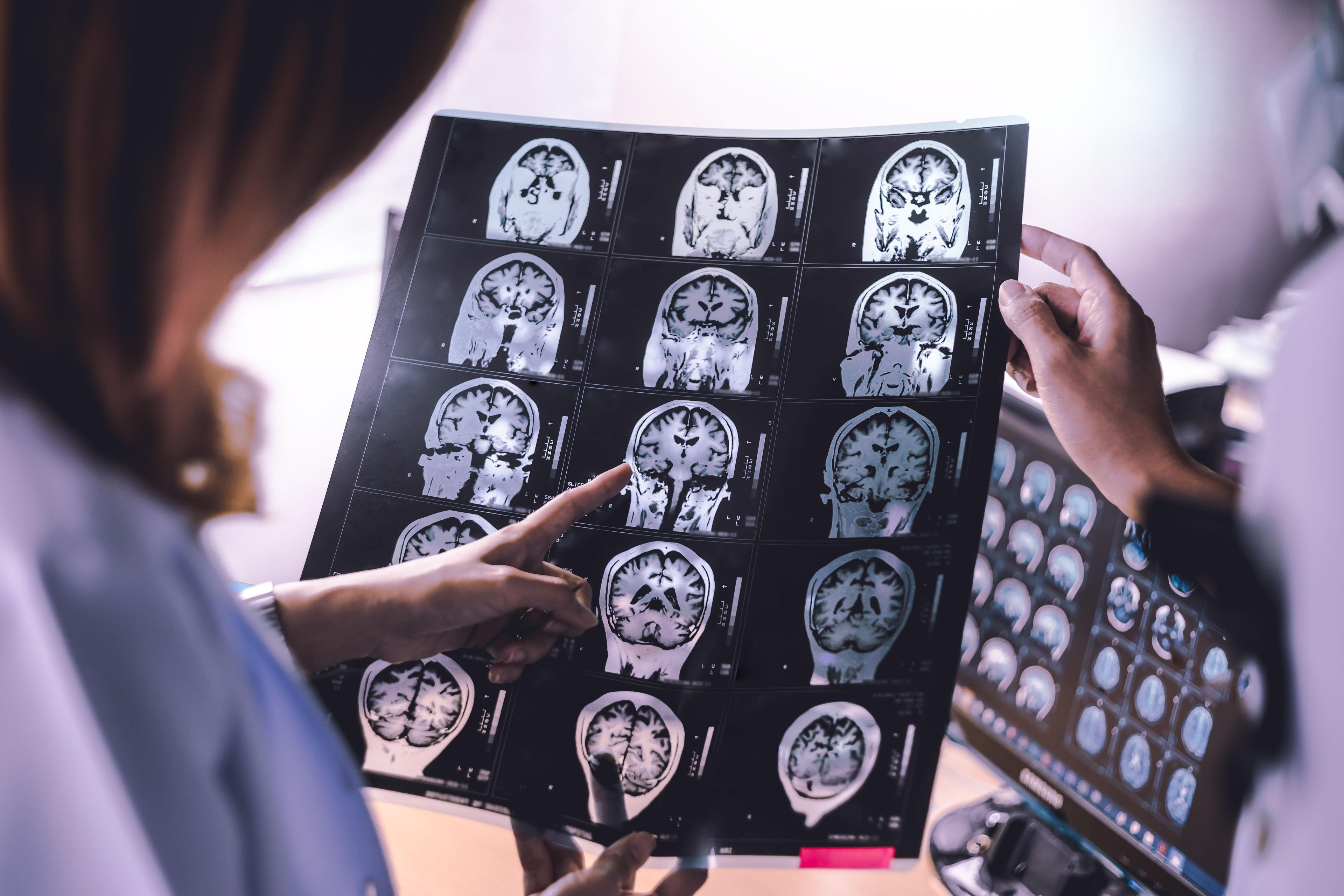 Health care worker looking at MRI scans of dementia -- Image credit: Atthapon | stock.adobe.com