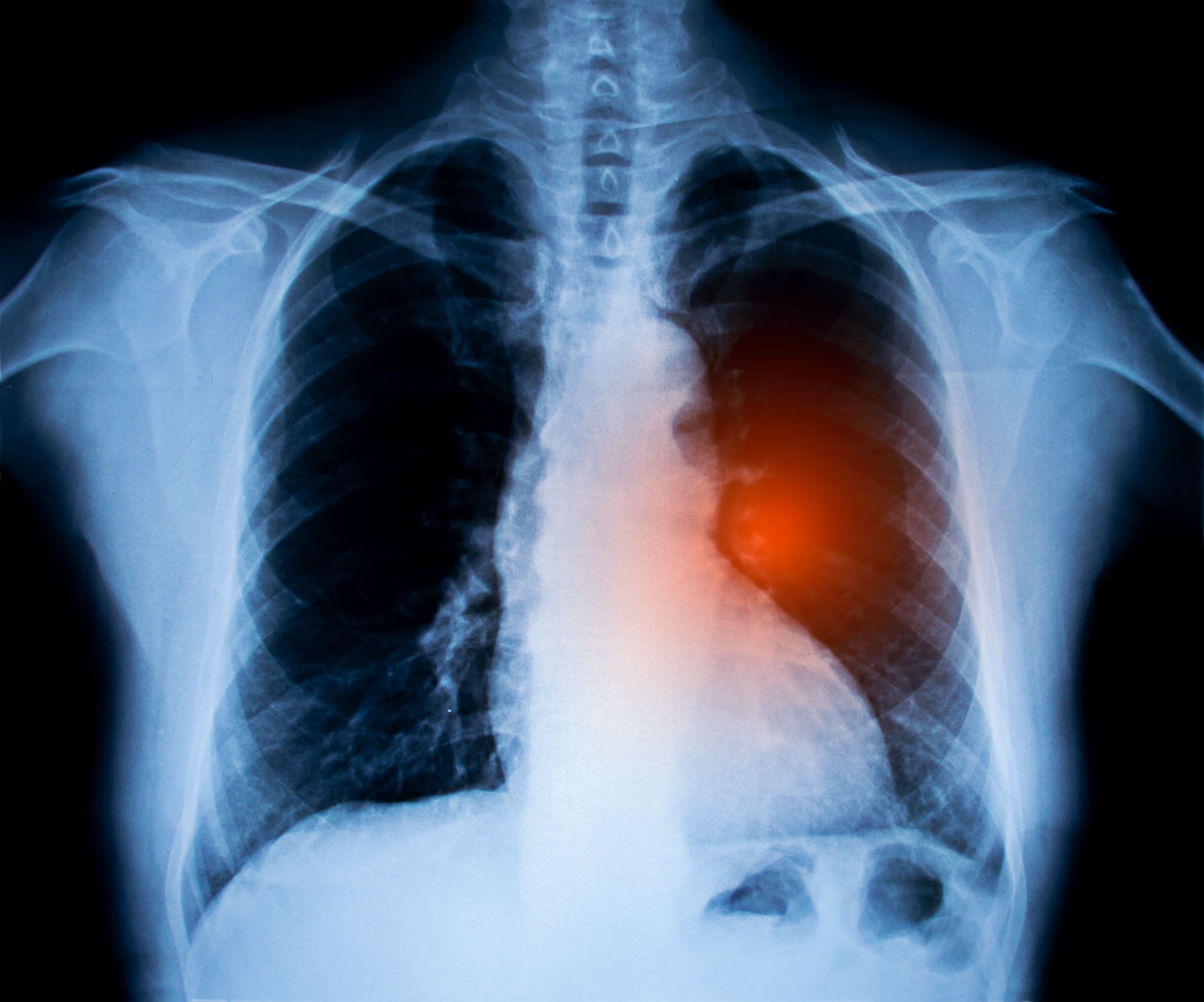 Lung cancer X-ray.