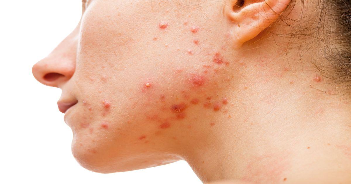 FDA Approves Minocycline Topical Foam for Acne Vulgaris