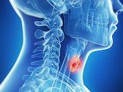 Thyroid Cancer Treatment: What is the Best Option?