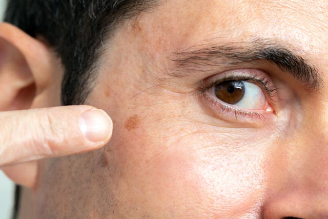 FDA Approves Tirbanibulin for Actinic Keratosis on Expanded Area of Face or Scalp