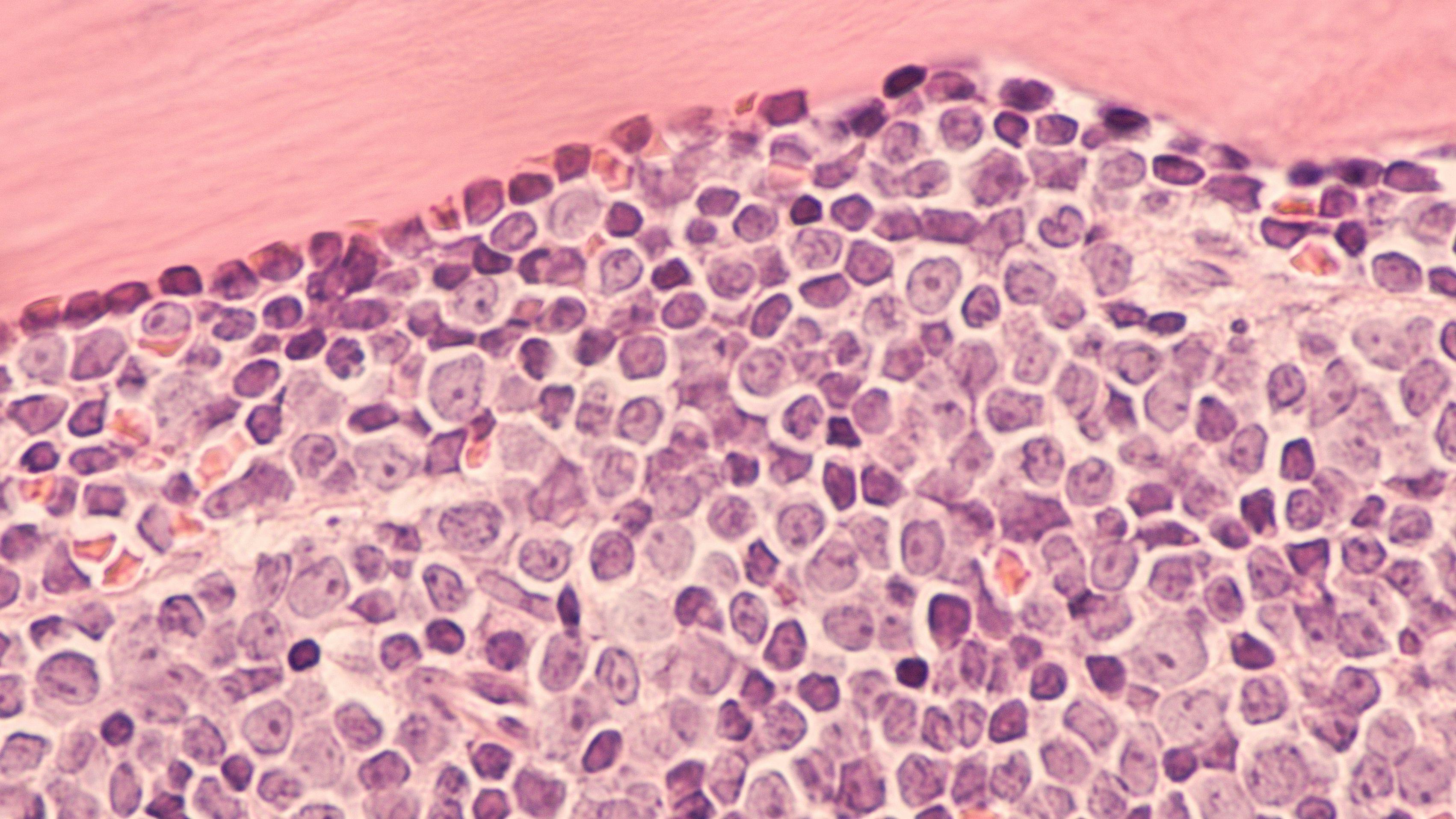 A staging bone marrow biopsy shows replacement of normal elements by diffuse large B-cell lymphoma.