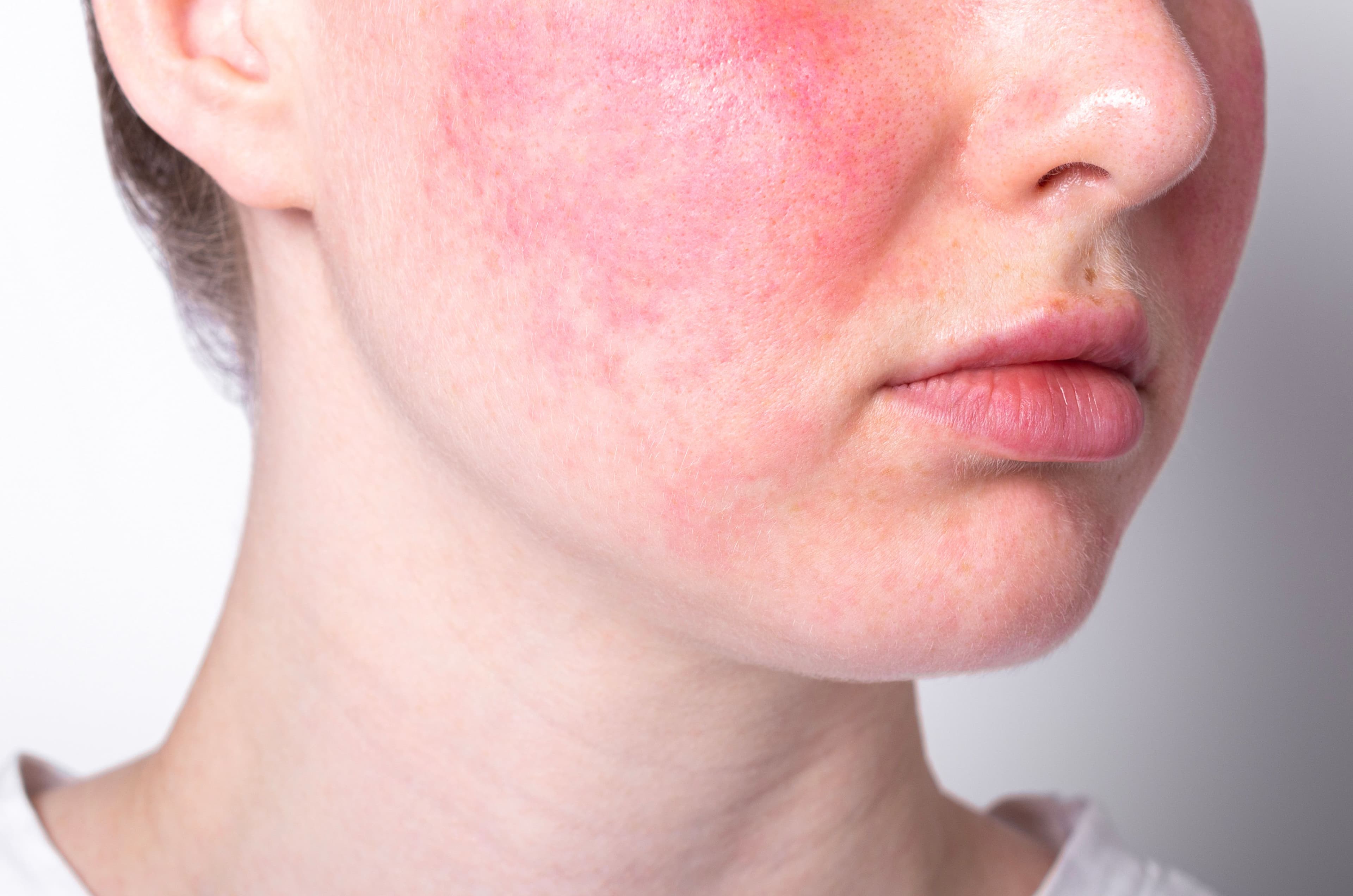 Woman with rosacea -- Image credit: iso100production | stock.adobe.com