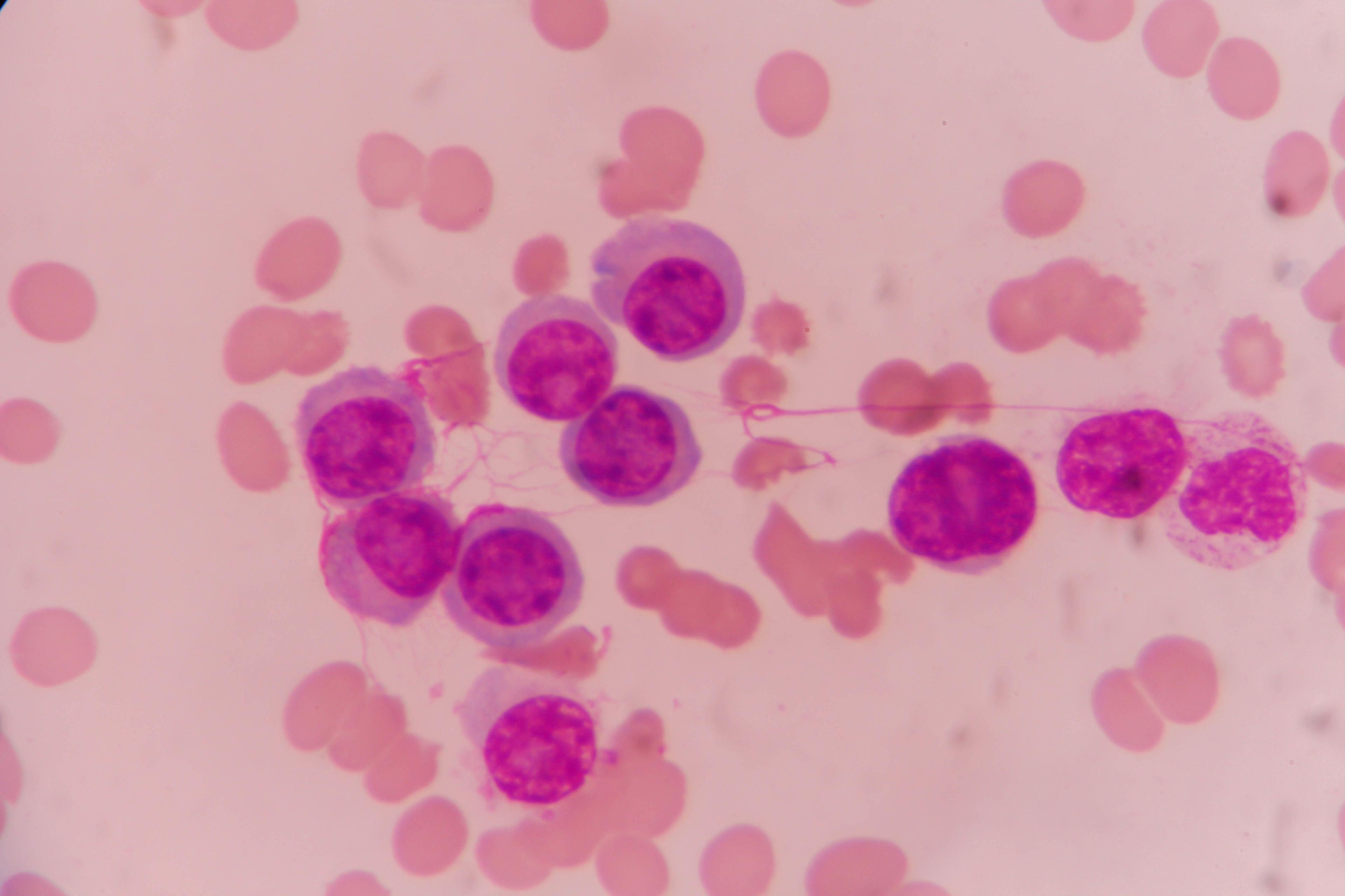 New Approach May Overcome Drug Resistance in Acute Myeloid Leukemia