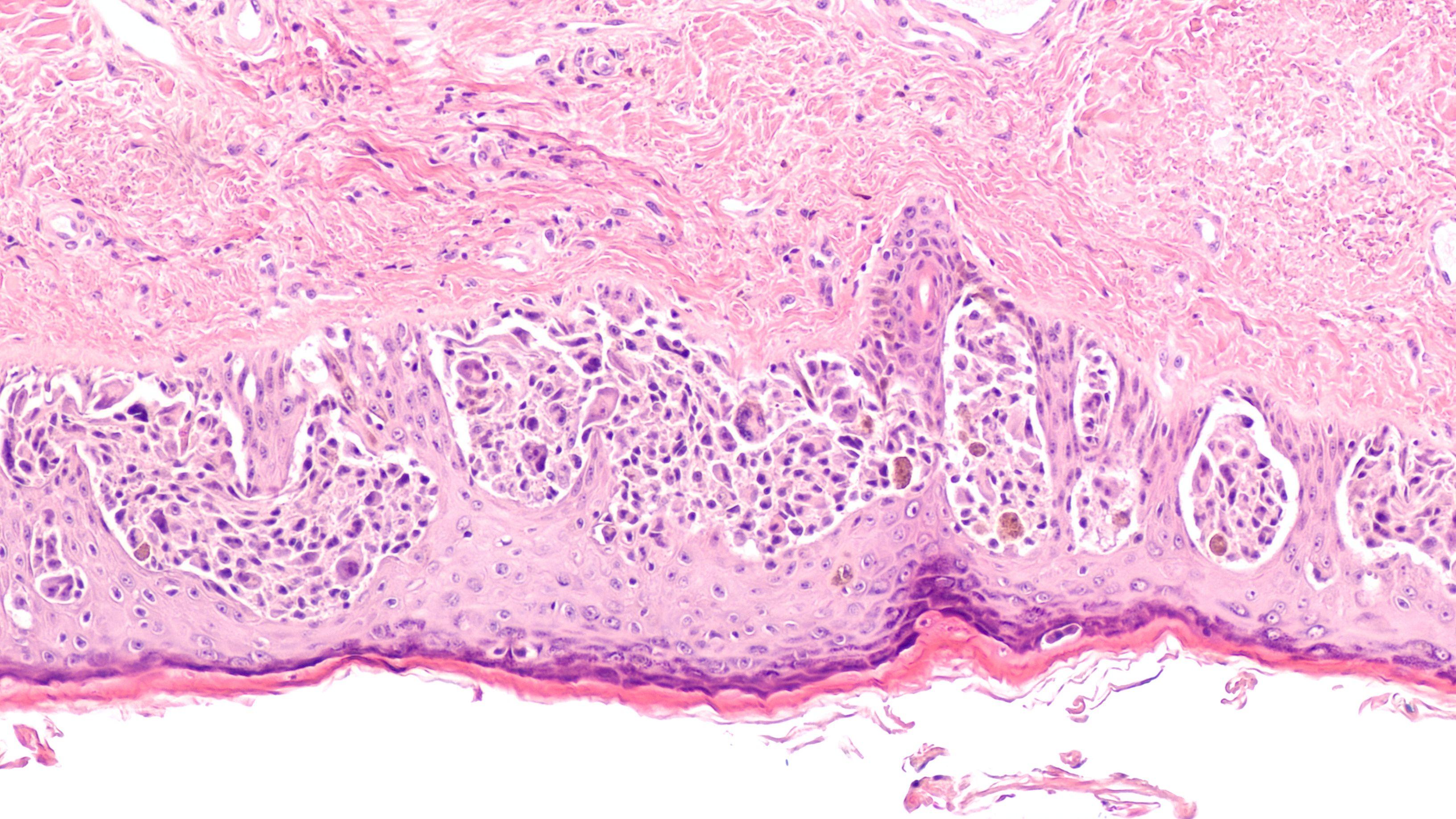 Melanoma in situ (MIS) is an early stage, while tumor cells are still confined to the epidermis, before invasion of dermis.