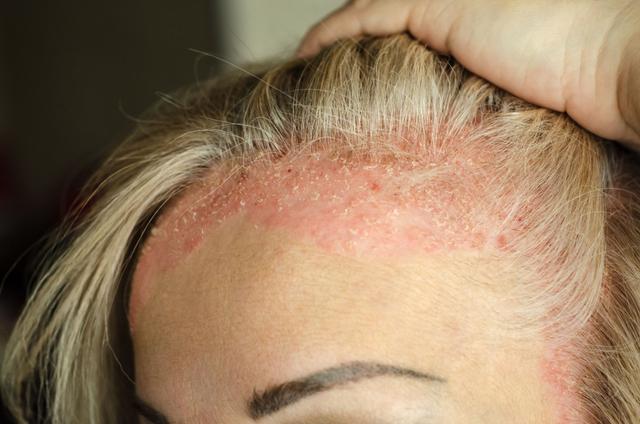 Psoriasis, Scalp, Body, FDA | Image Credit: Егор Кулинич - stock.adobe.com