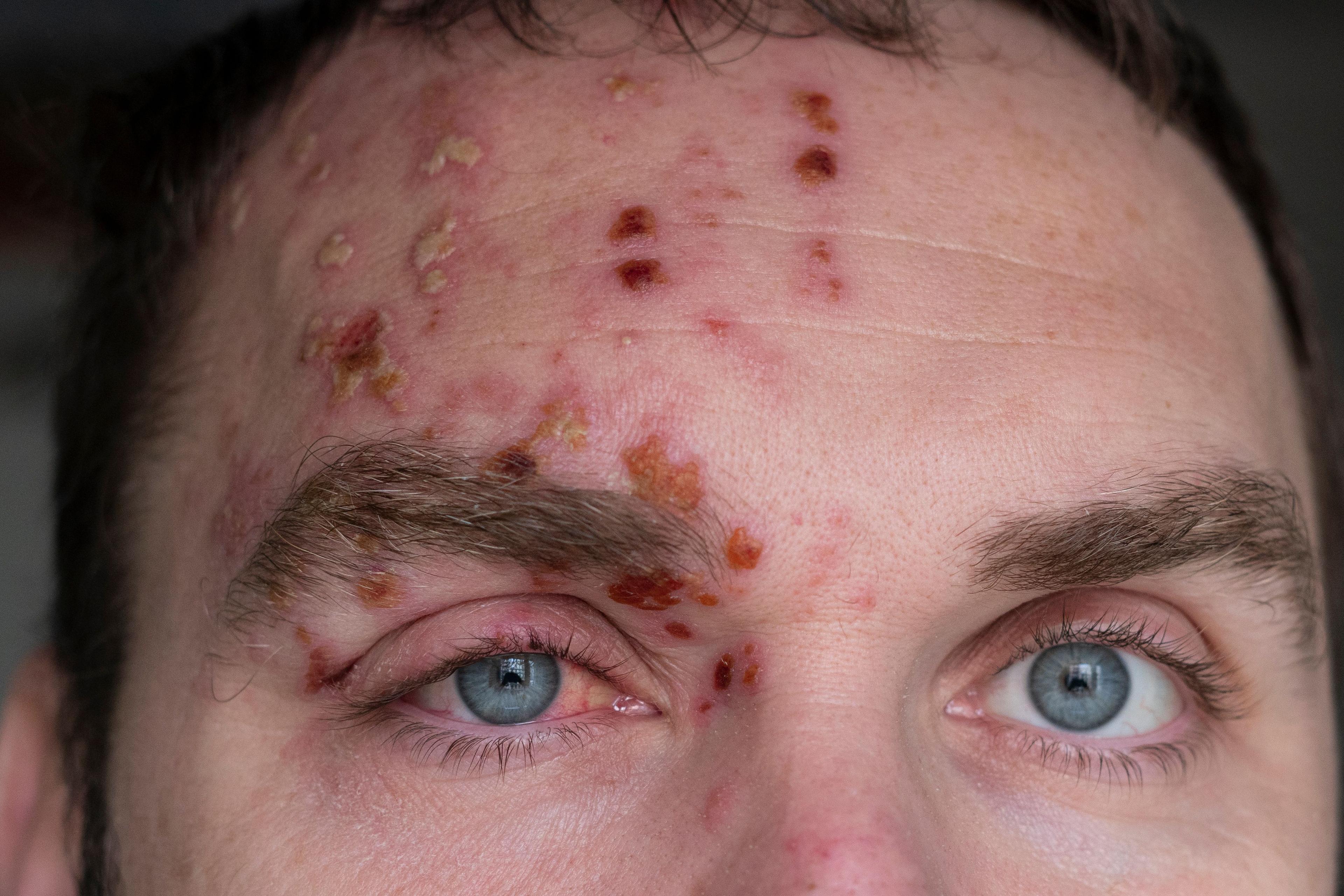 Man with Herpes Zoster (shingles) on the face, close up. Inflamed eyelid and red eye of a man suffering from herpes on the face. Purulent blisters on the face during Shingles  - Image credit: Yury | stock.adobe.com 