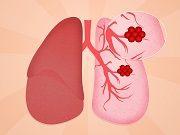 Lung Cancer Drug Granted Breakthrough Designation