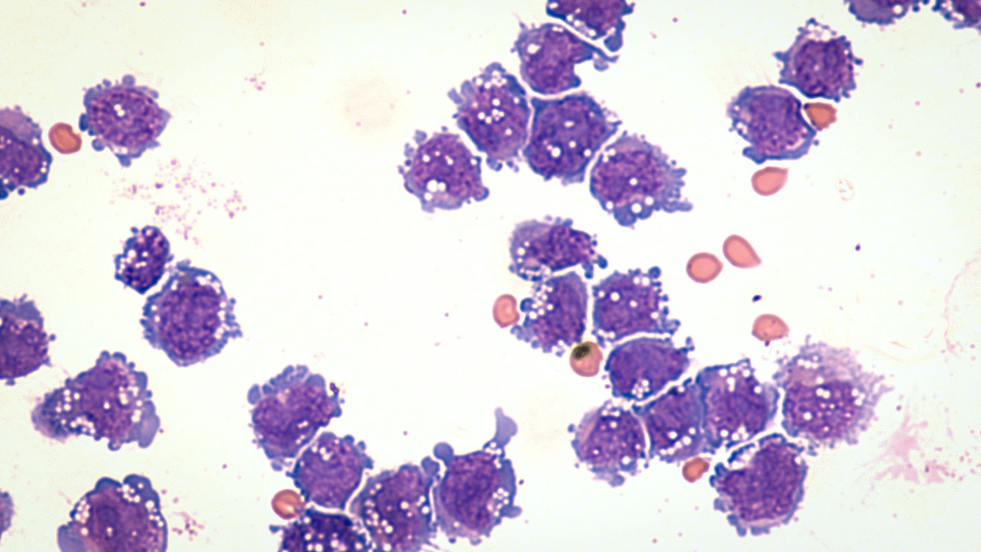 microscopic image of diffuse large B-cell lymphoma, a type of non Hodgkin lymphoma.