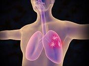 Experimental Drug Substantially Decreases Lung Cancer Mortality