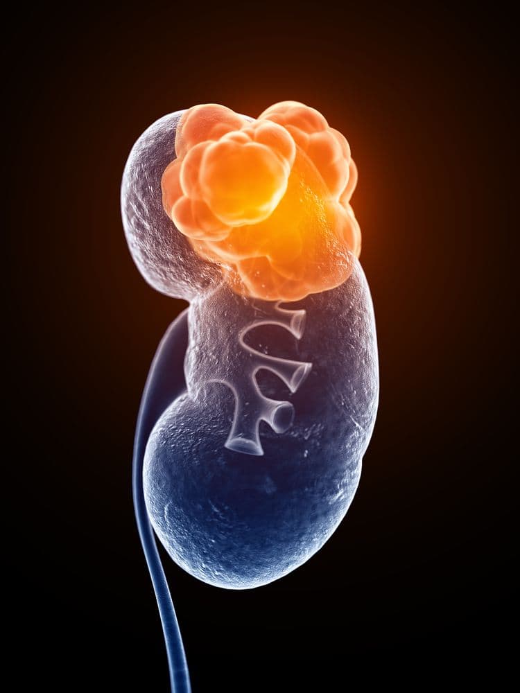 Nonsteroidal Mineralcorticoid Receptor Antagonists in Managing Hyperkalemia