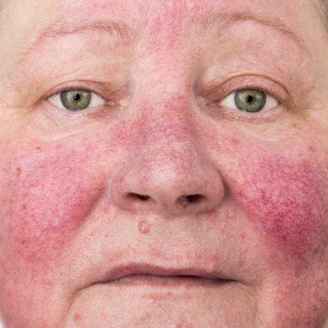 Rosacea Awareness Month Focuses on Management Options