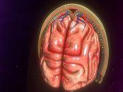 Interleukin Inhibitor May be an Effective Stroke Treatment