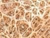 New Procedure Improve Efficacy of Bone Marrow Transplants