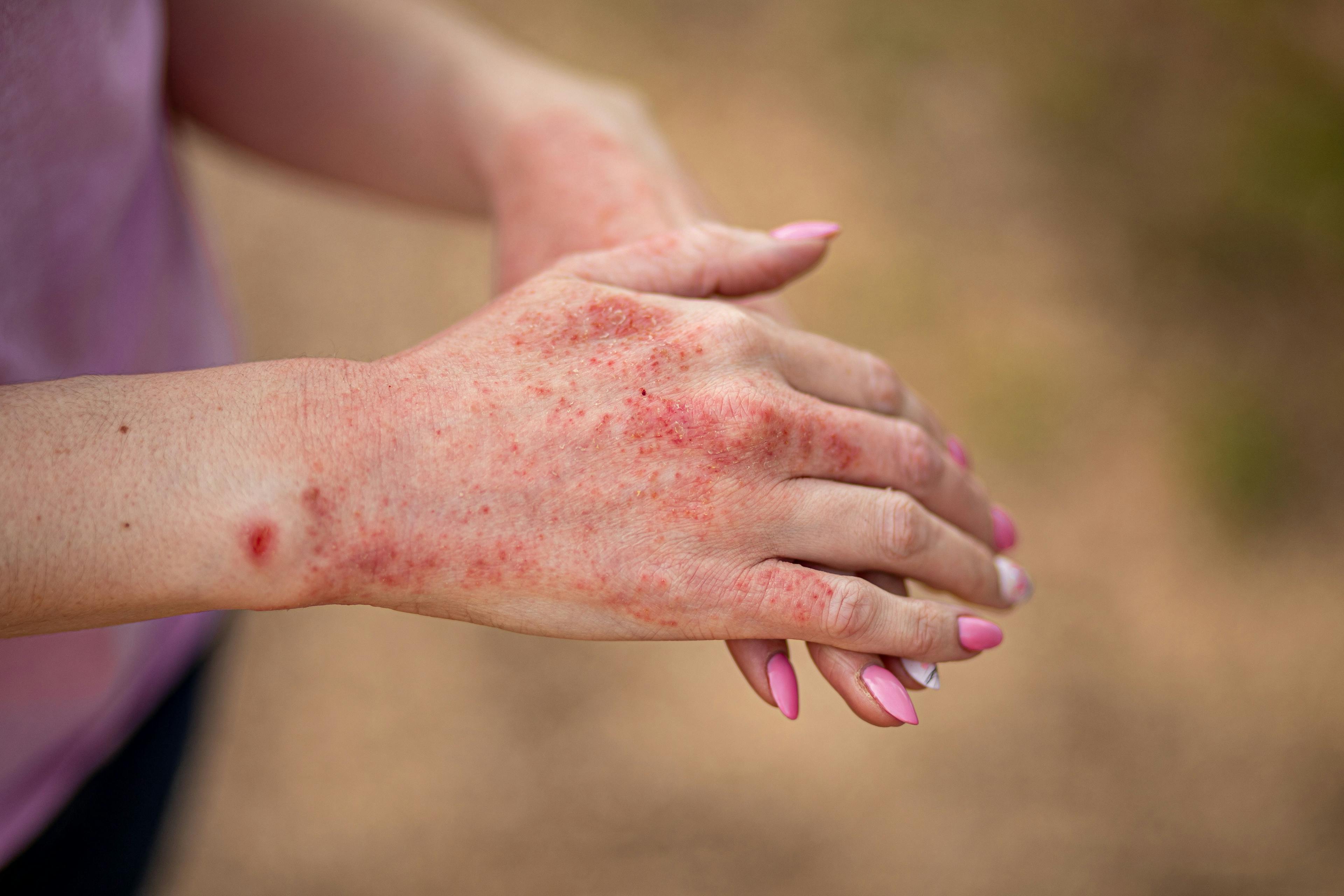 Atopic Dermatitis, Eczema, Rash | Image Credit: InfiniteStudio - stock.adobe.com