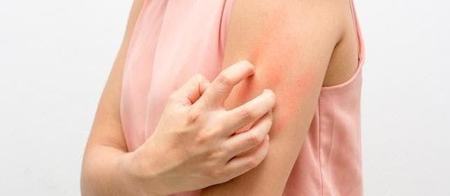 Scabies: International Experts' Call to Action