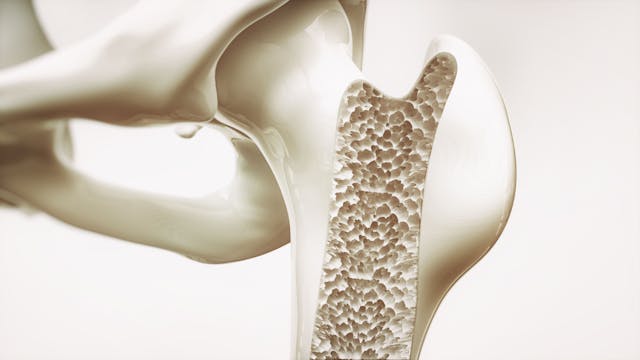 Osteoporosis stage 4 of 4 - upper limb bone - 3d rendering | Image Credit: crevis - stock.adobe.com