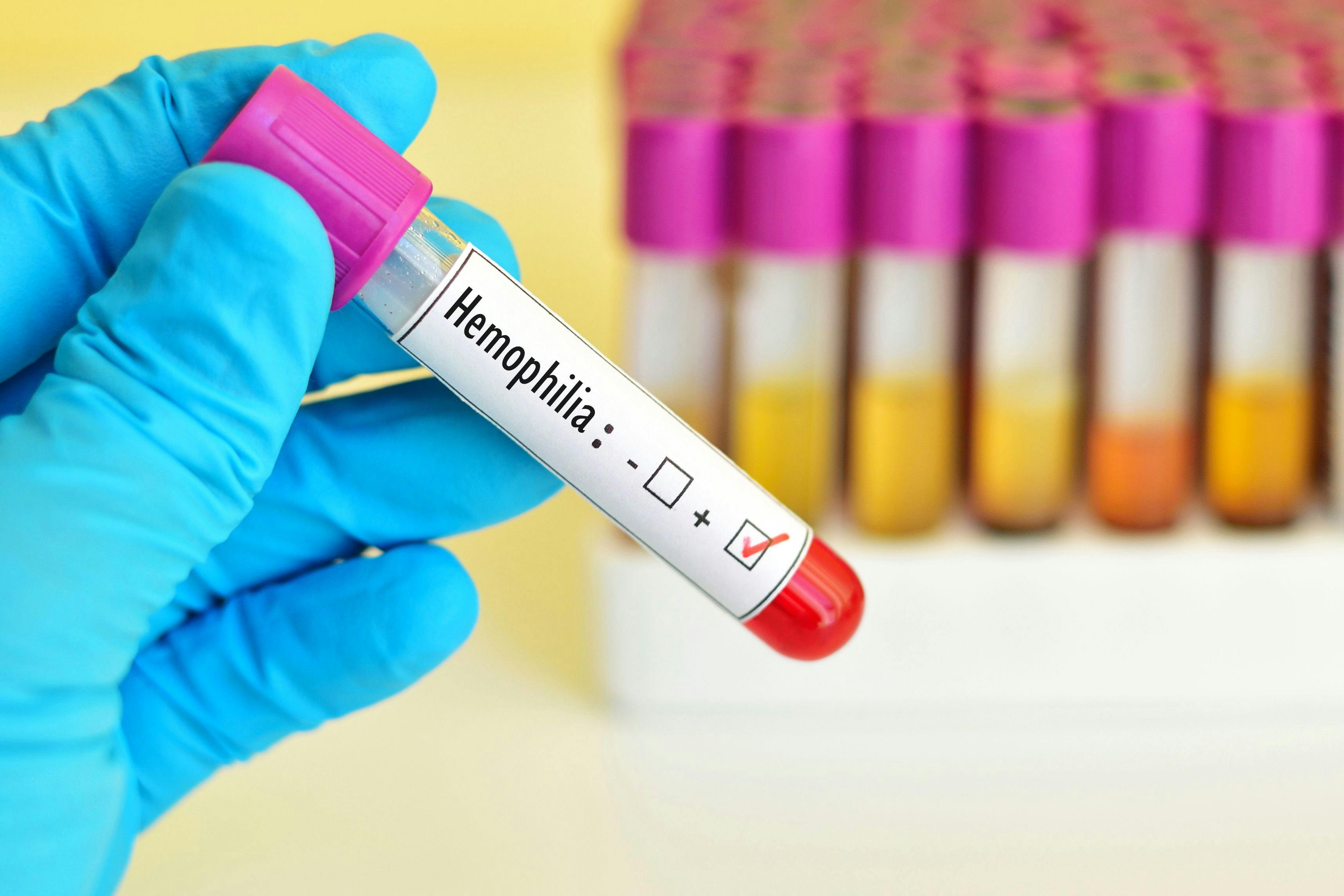 Blood sample positive for hemophilia -- Image credit: jarun011 | stock.adobe.com