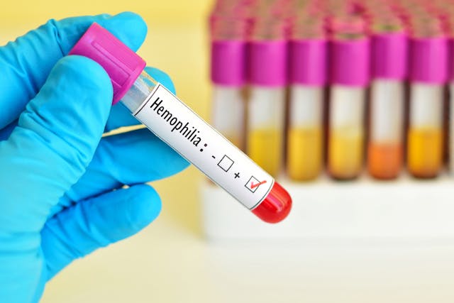 Blood sample positive for hemophilia -- Image credit: jarun011 | stock.adobe.com
