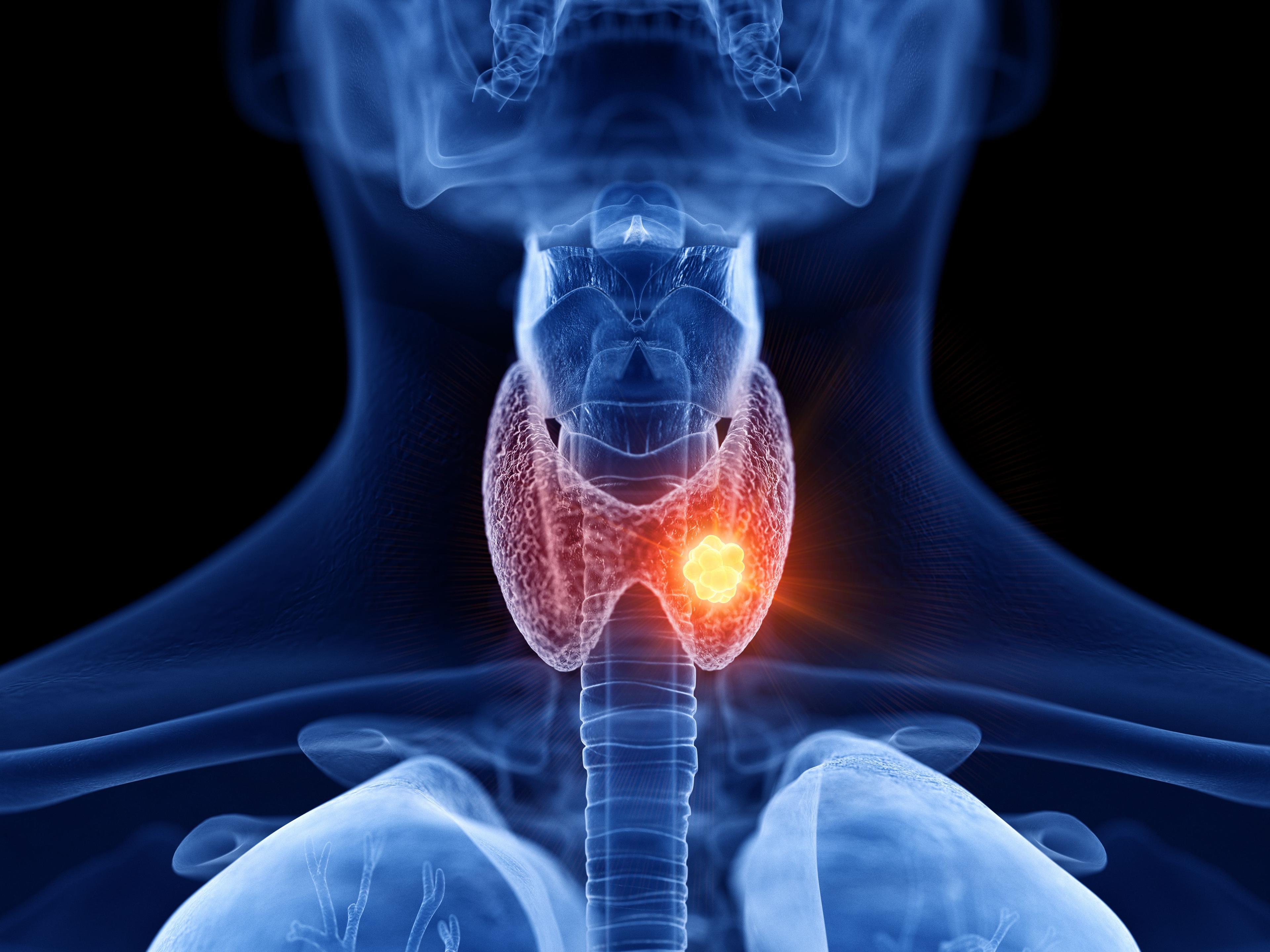 Thyroid cancer -- Image credit: Sebastian Kaulitzki | stock.adobe.com