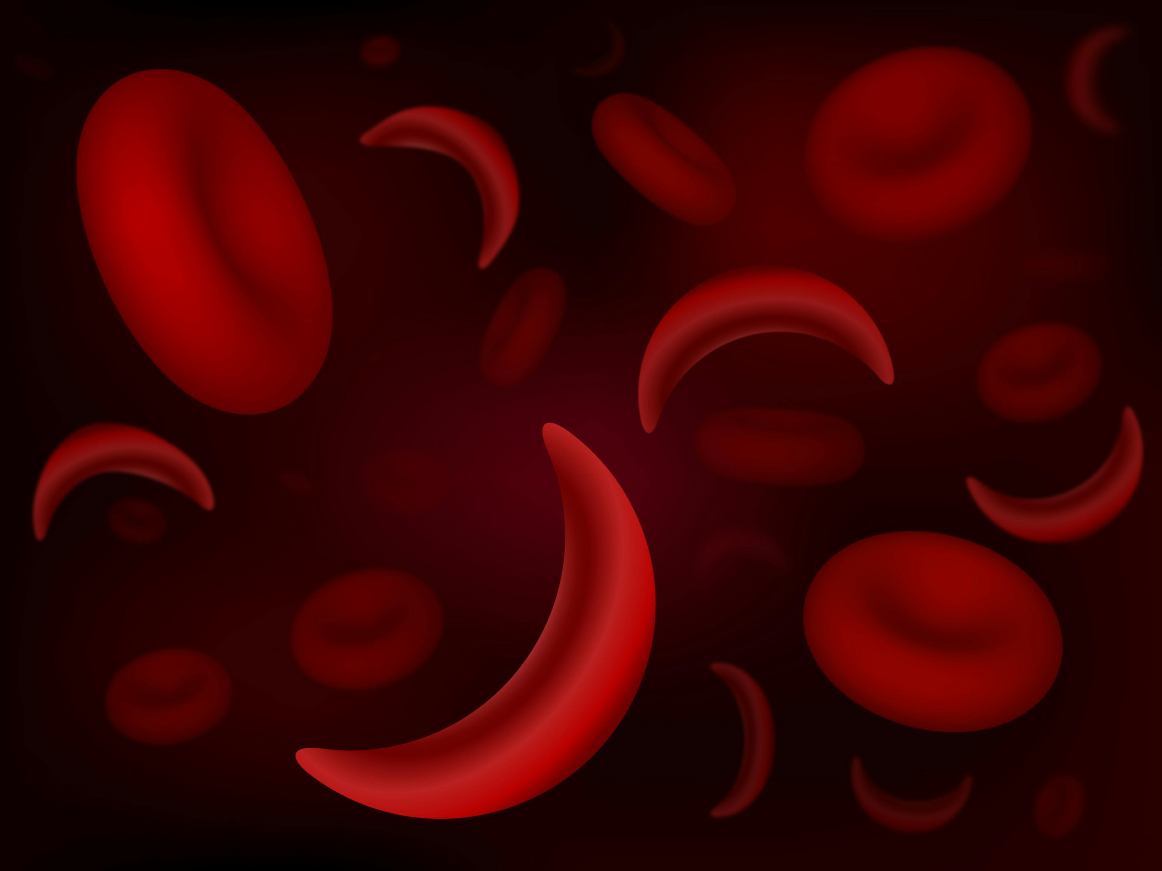 Sickle cell disease blood cells -- Image credit: extender_01 | stock.adobe.com