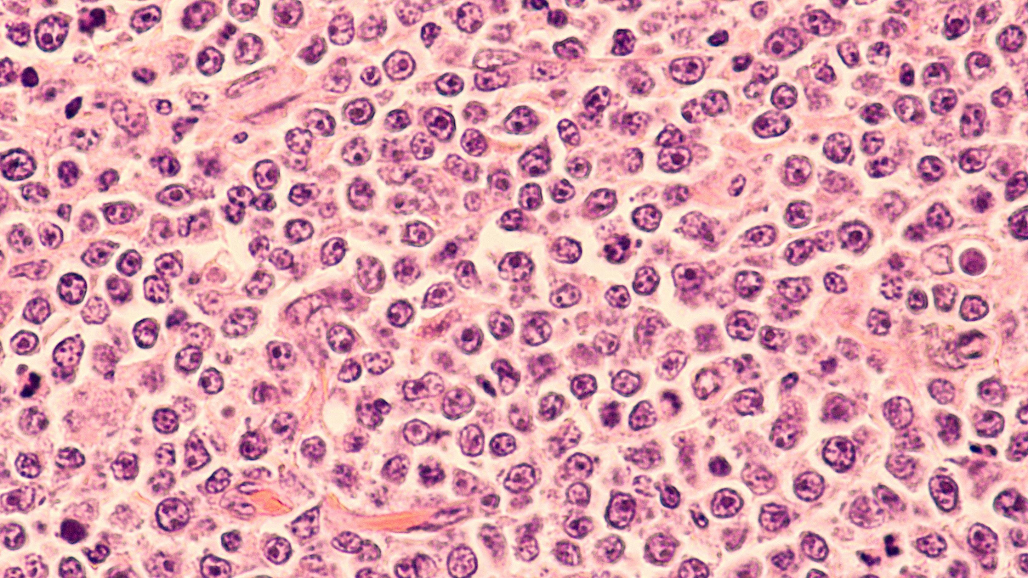 Photomicrograph of a diffuse large B-cell lymphoma (DLBCL) a type of non-Hodgkin lymphoma.