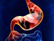 FDA Approves Gastric Cancer Treatment