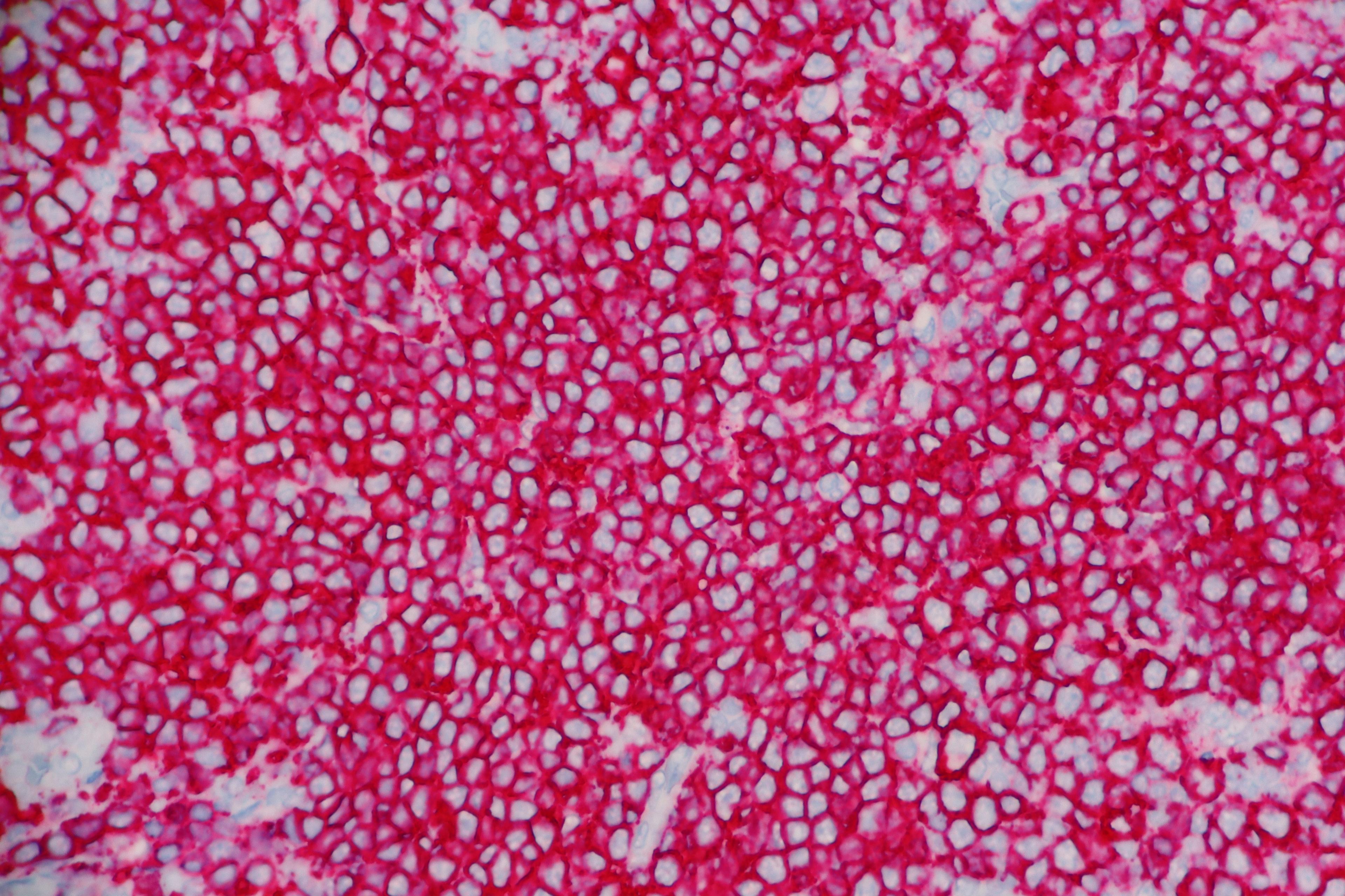 High grade follicular lymphoma with diffuse Membrane expression (red) of the B-cell marker called CD 20