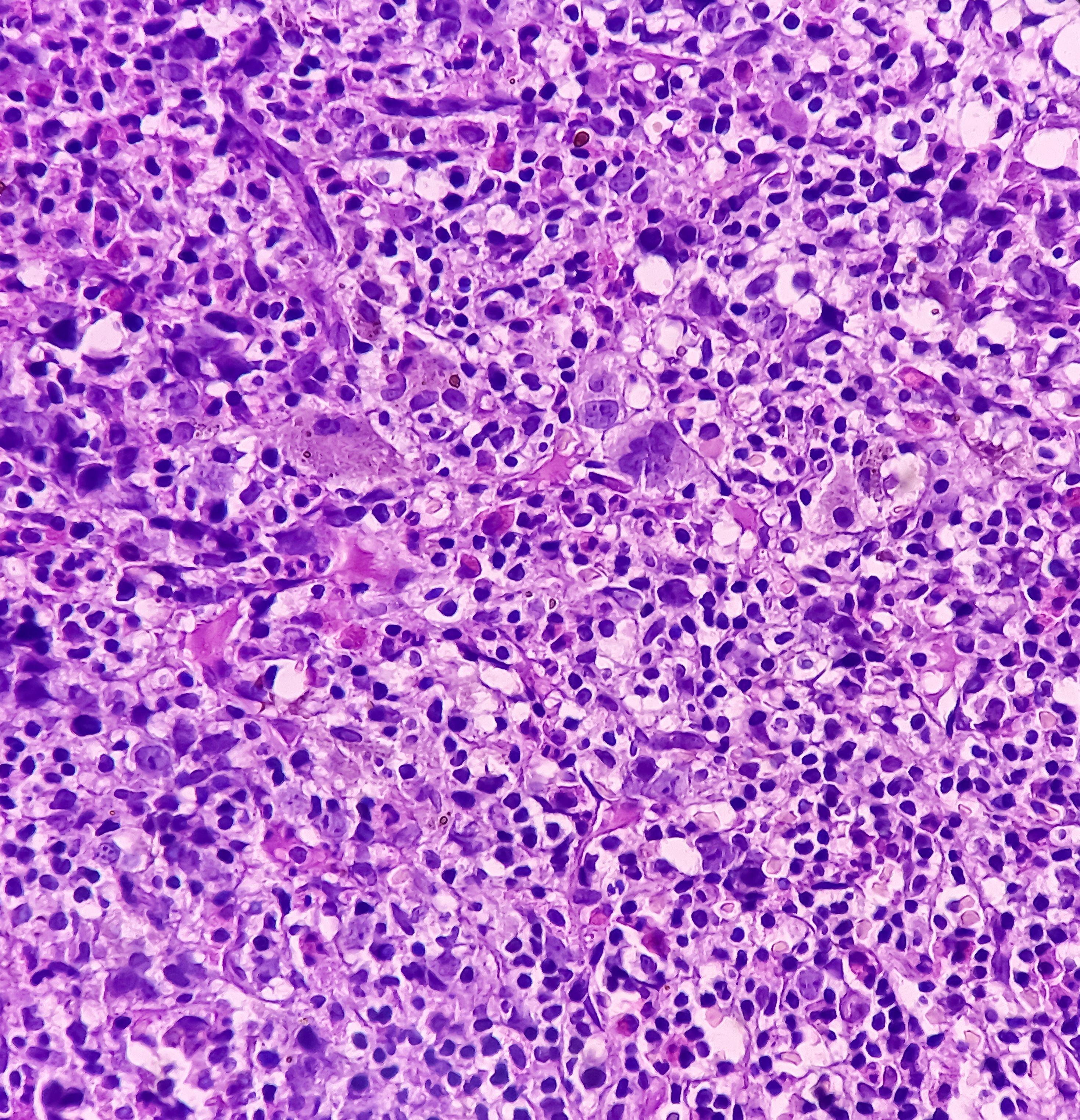 Microscopic view of non-Hodgkin lymphoma.