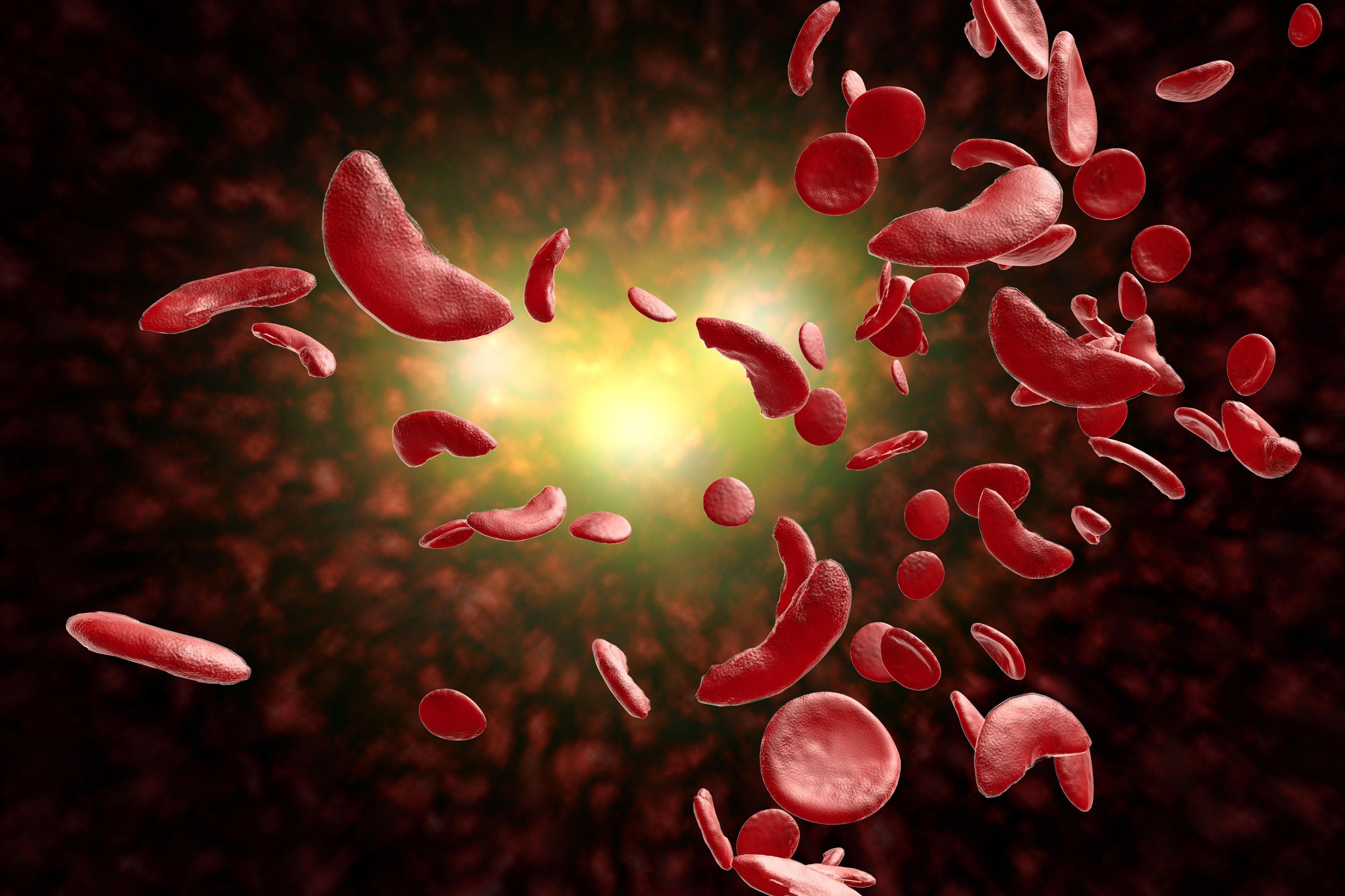 Sickle Cell Disease Treatment Withdrawn | Image Credit: Ezume Images - stock.adobe.com