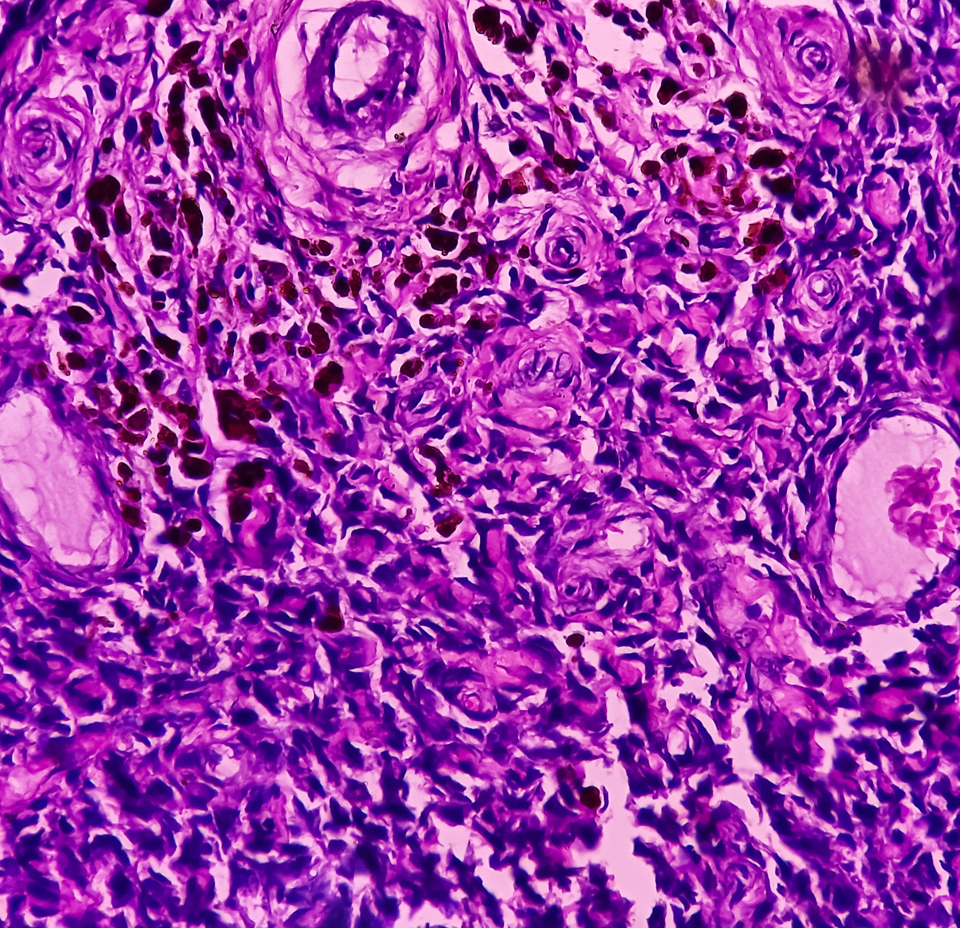 Synovial sarcoma cells.