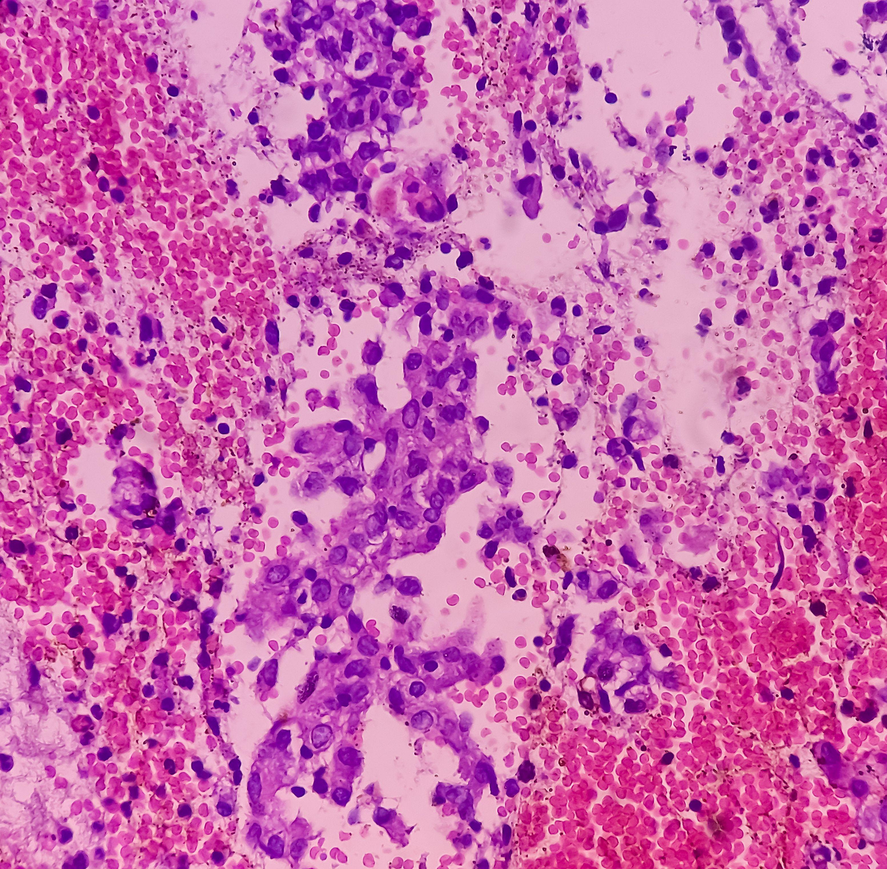 Endometrial adenocarcinoma.