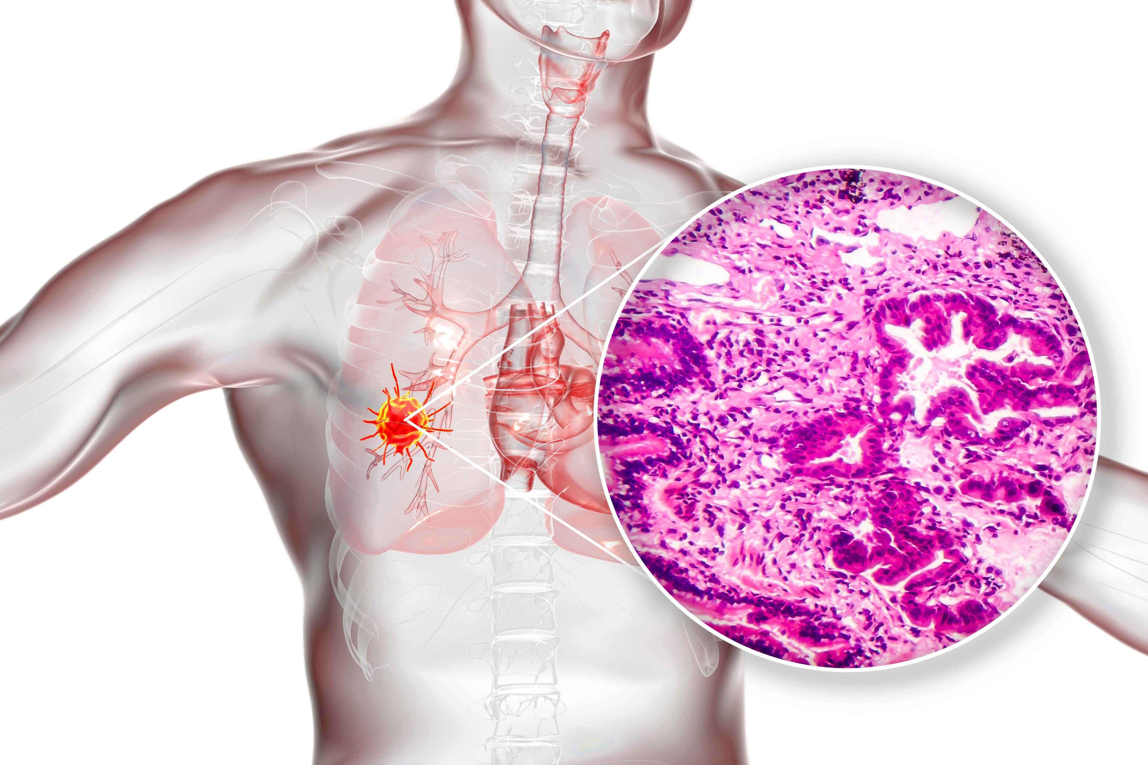 Lung cancer, 3D illustration and photo under microscope. Light micrograph showing lung adenocarcinoma