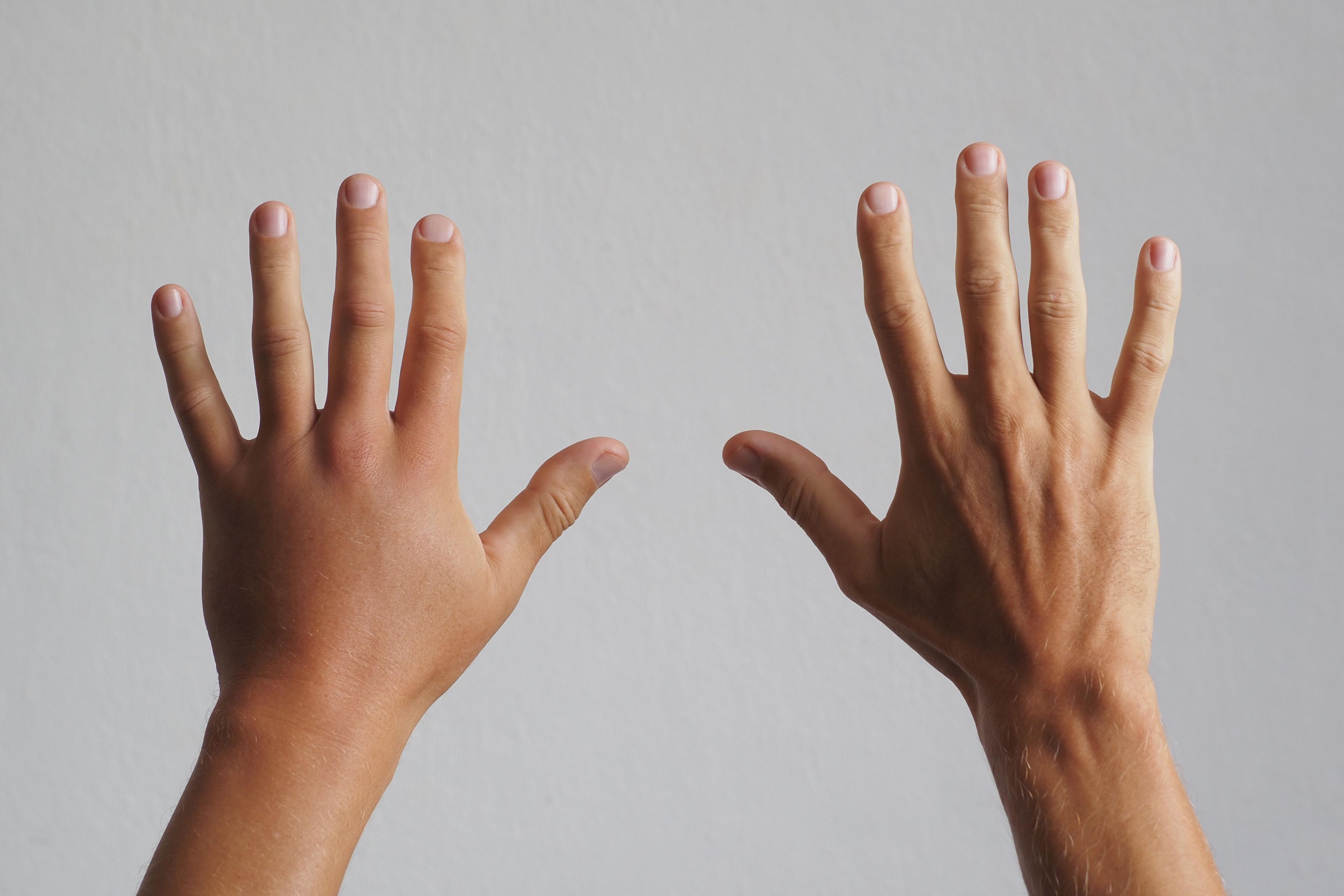 Male hand, swollen after a wasp bite.