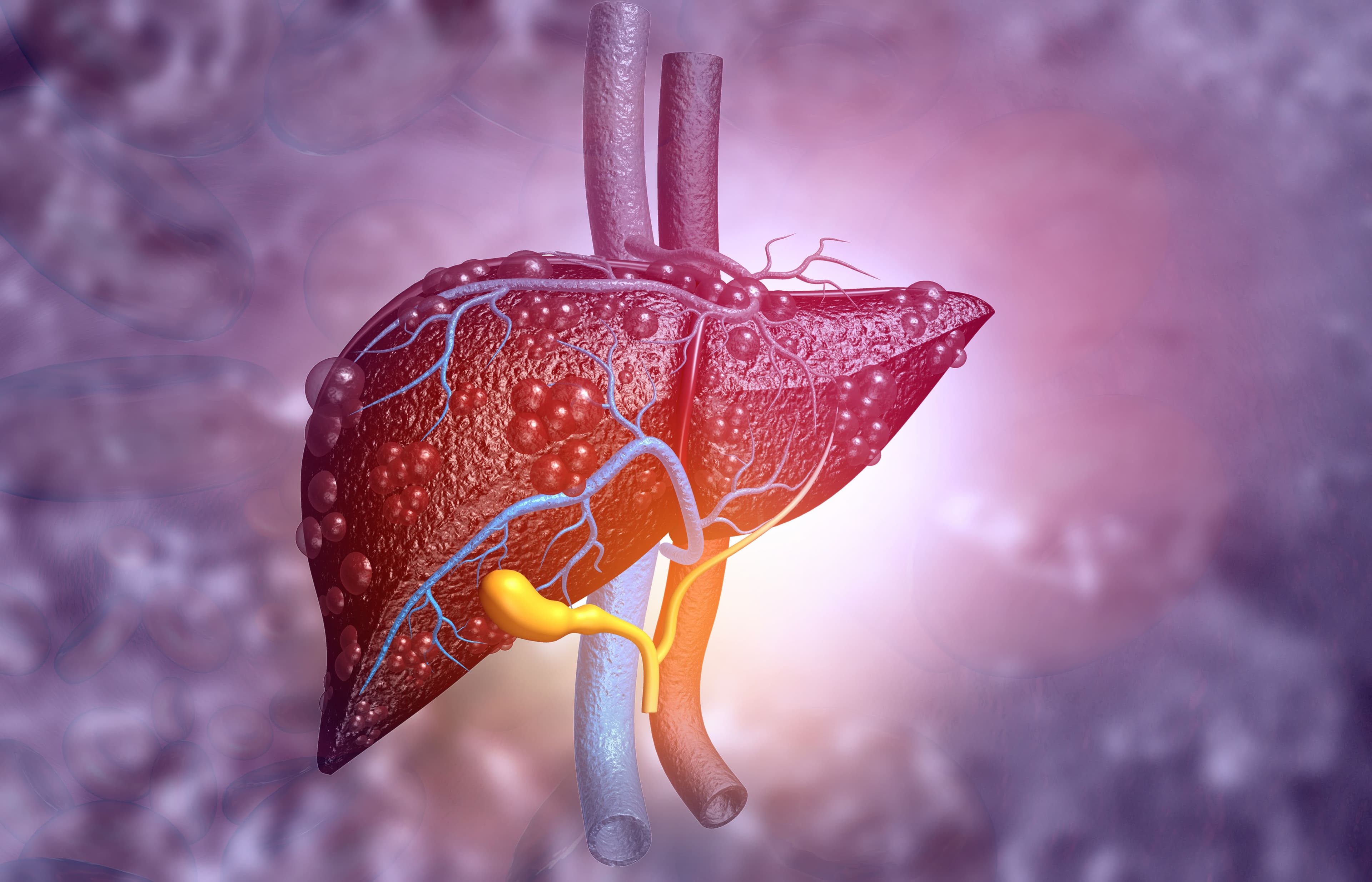 Upcoming Drug Approvals Fill Unmet Needs in Nonalcoholic Steatohepatitis