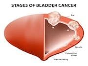 FDA Approves Keytruda for Advanced or Metastatic Urothelial Carcinoma