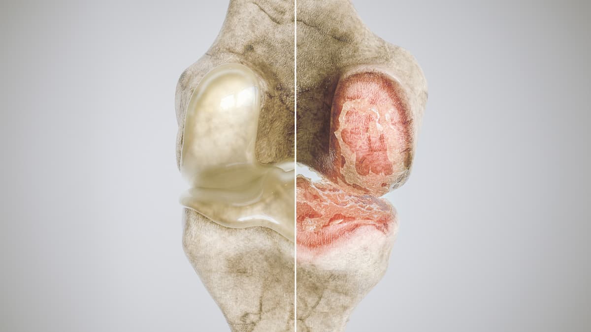 healthy knee and osteoarthritis knee in comparison - high degree of detail 