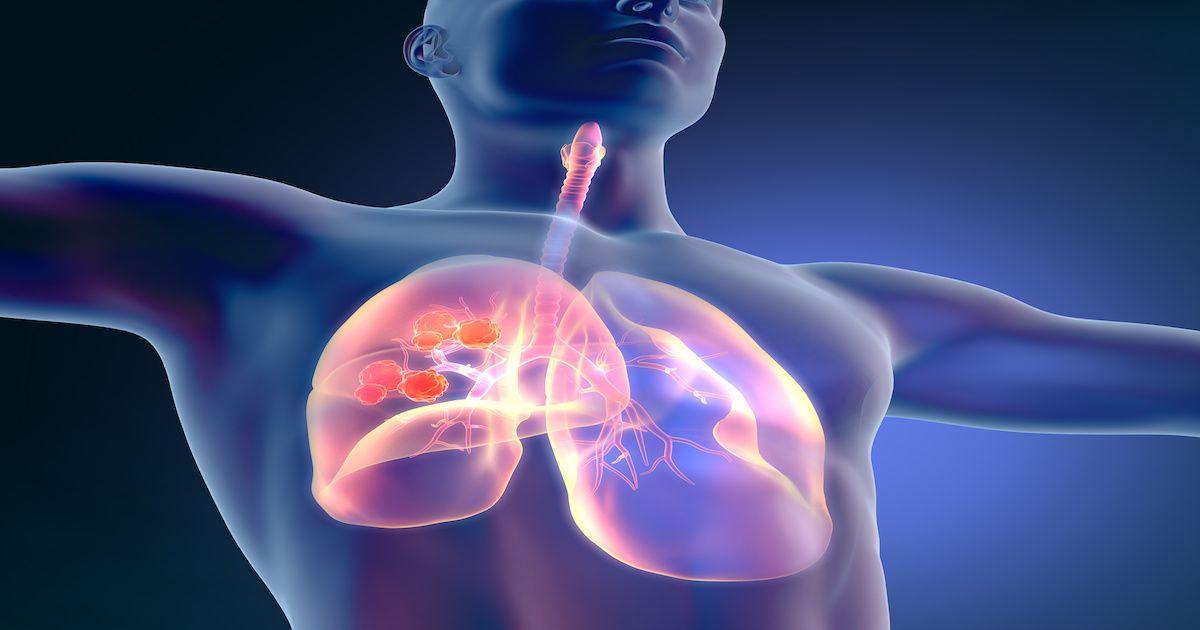 Ramucirumab, Erlotinib Combo a Promising First-line EGFR-Mutated NSCLC Treatment