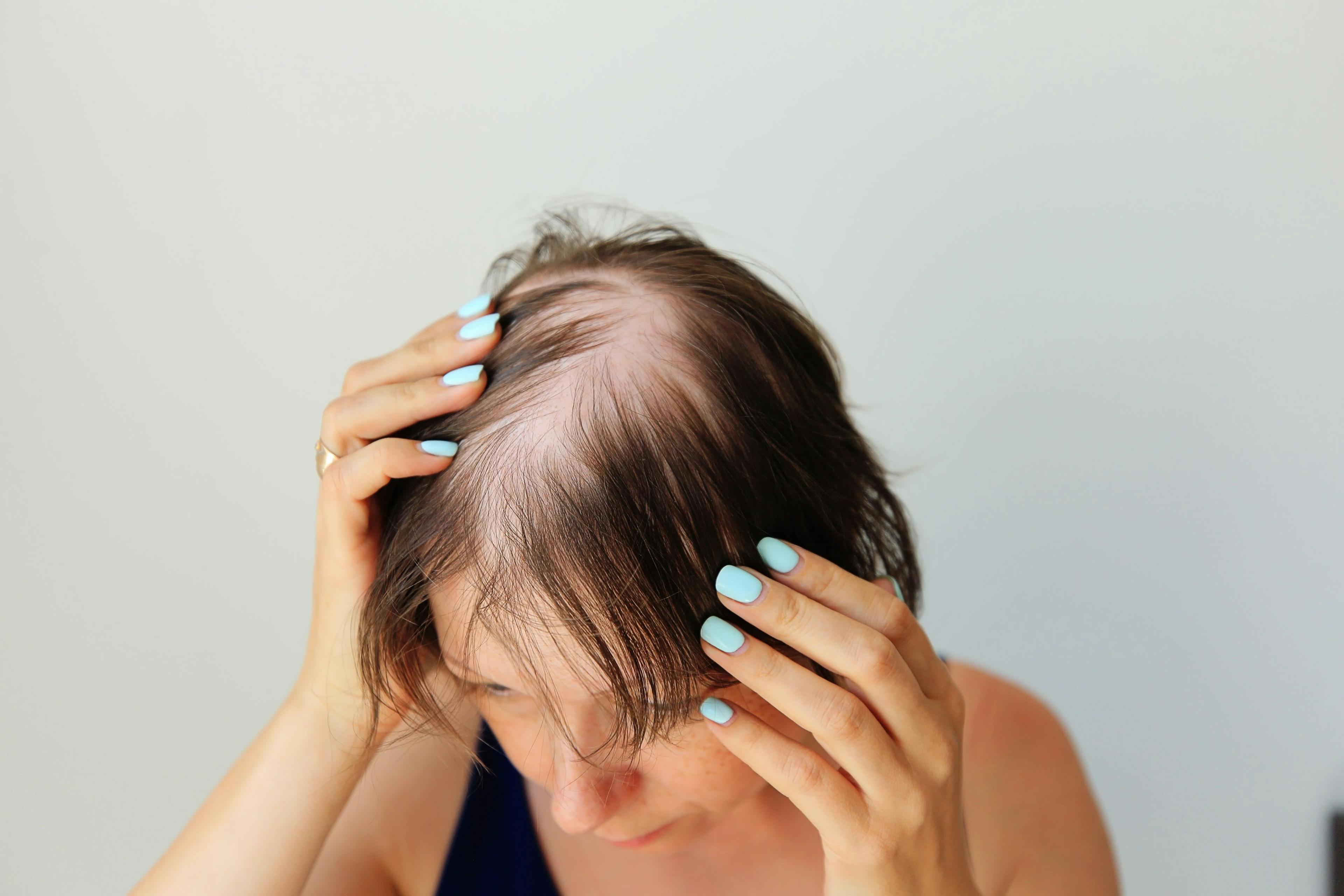 Hair loss in the form of alopecia areata. Bald head of a woman. Hair thinning after covid. Bald patches of total alopecia - Image credit: Nadya Kolobova | stock.adobe.com 