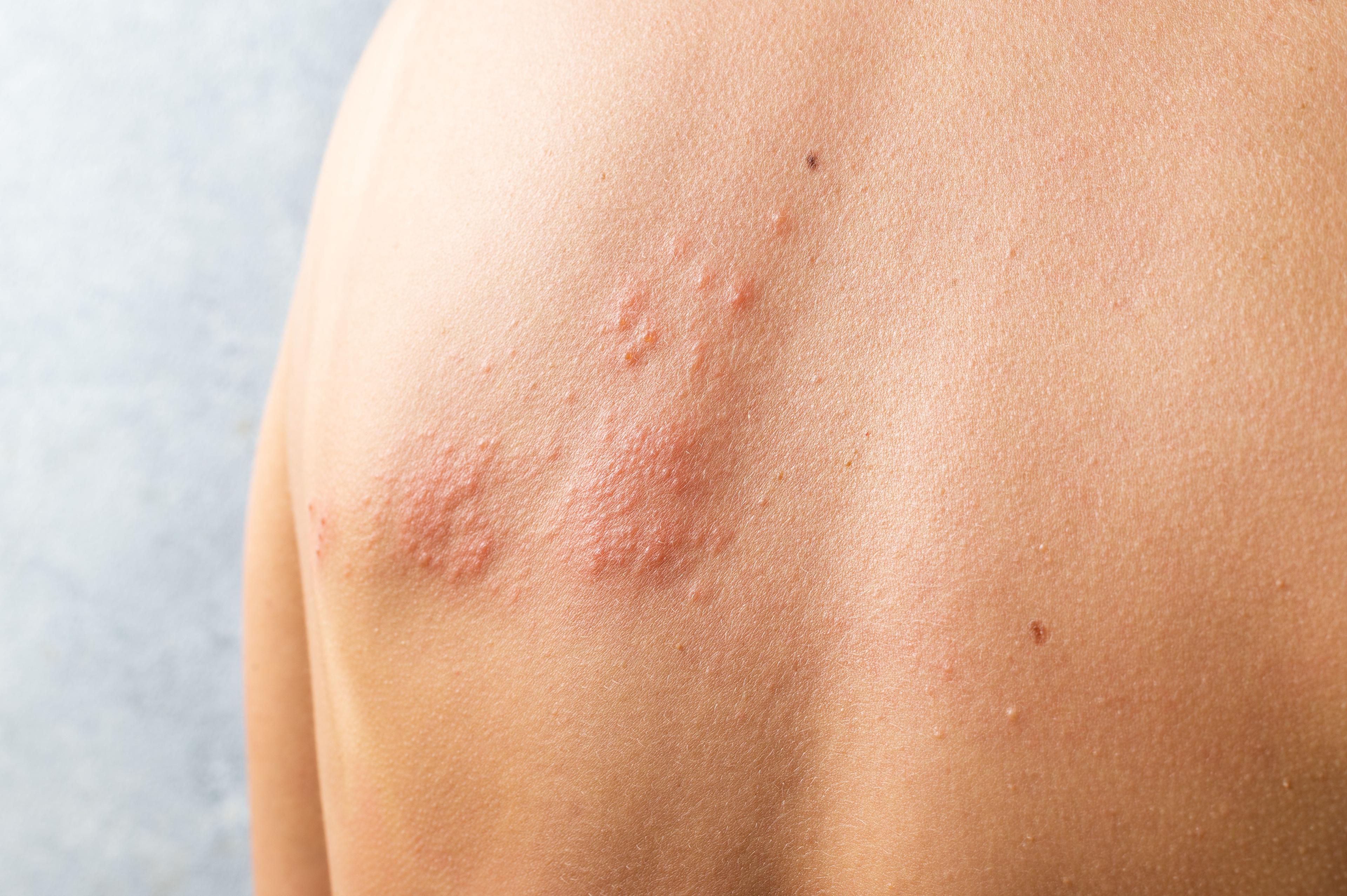 Skin infected Herpes zoster virus. Herpes Virus on body. urticaria rash. atopic dermatitis on body - Image credit: sashka1313 | stock.adobe.com 