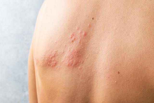 Skin infected Herpes zoster virus. Herpes Virus on body. urticaria rash. atopic dermatitis on body - Image credit: sashka1313 | stock.adobe.com 