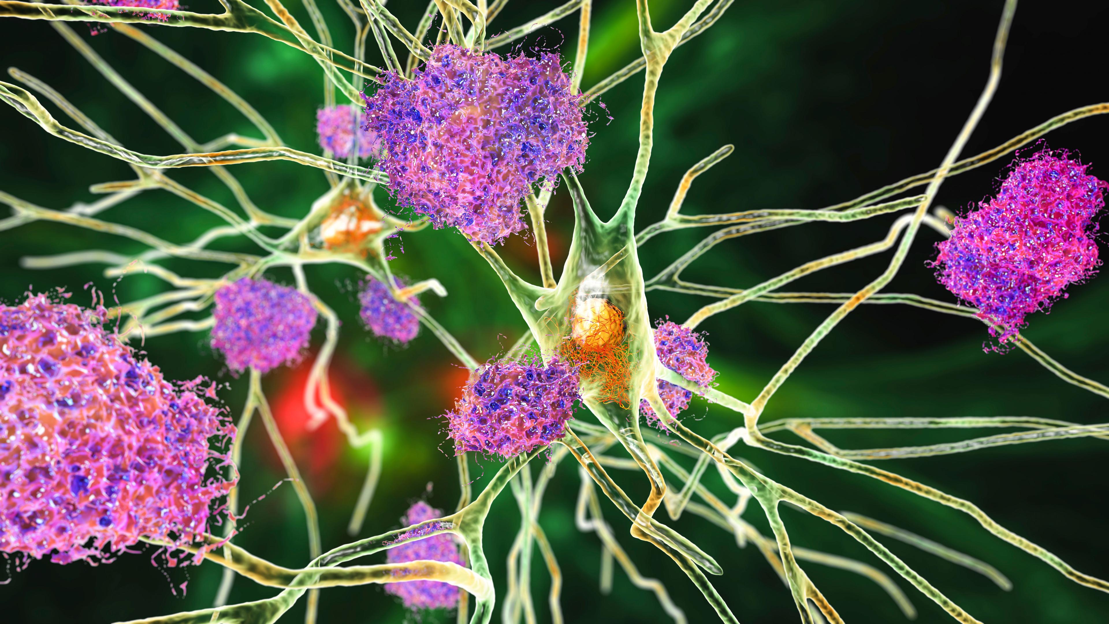 Neurons in Alzheimer disease -- Image credit: Dr_Microbe | stock.adobe.com