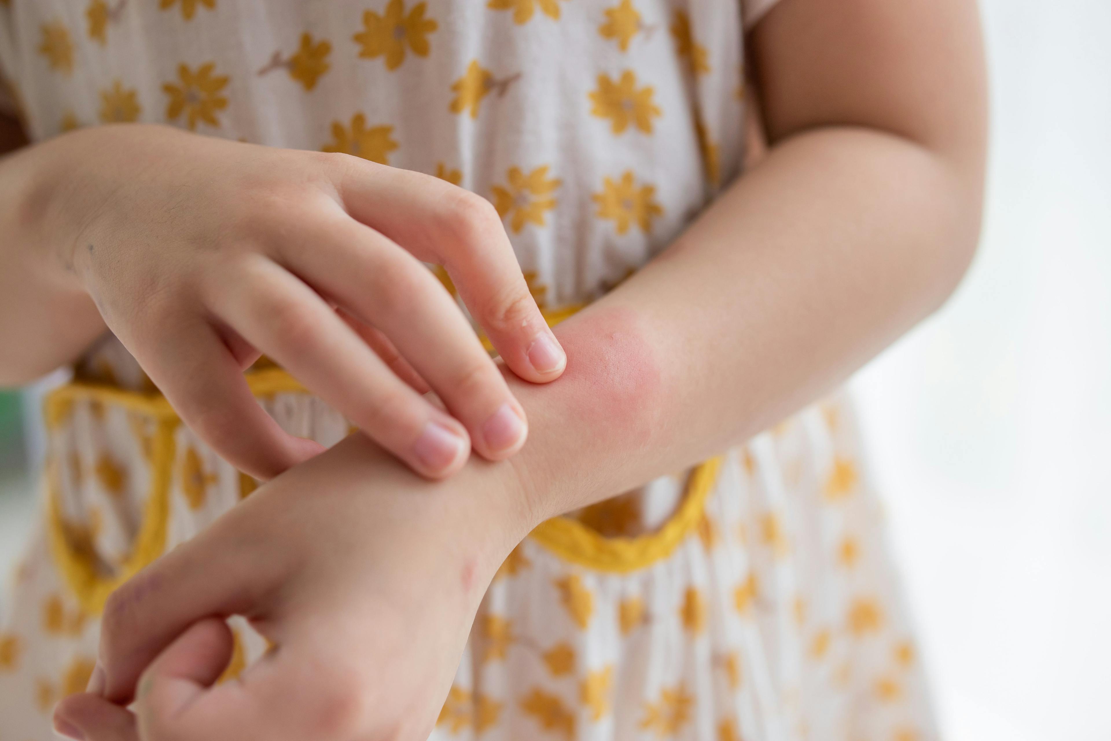 childhood eczema and vaping/Image Credit: © Piman Khrutmuang - stock.adobe.com